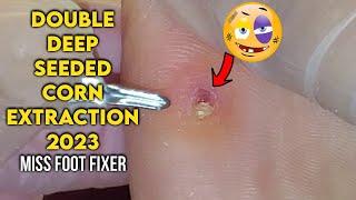 EXTRACTION OF DOUBLE DEEP SEED CORN ON SOLE OF FEET 2023 BY FAMOUS PODIATRIST MISS FOOT FIXER