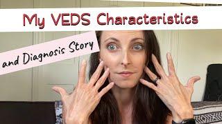 My VEDS Characteristics and Diagnosis Story (Vascular Ehlers-Danlos syndrome)