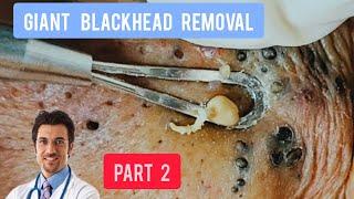 Massive blackhead removal inside a dermatology clinic | @Dr.AMAZINGSKIN