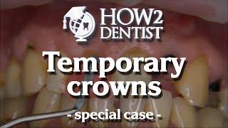 How to make temporary crowns in the front / How 2 Dentist