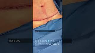 The power of Exofin fusion! #scarhealing #tummytuckscar #tummytuckbeforeandafter