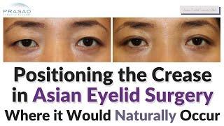 Determining the Natural Placement of an Eyelid Crease in Asian Double Eyelid Surgery