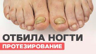 Отбила ногти на ногах| Хирург не помог| Протезирование