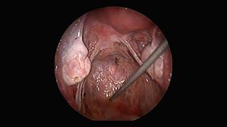 An example of complete excision of superficial peritoneal endometriosis