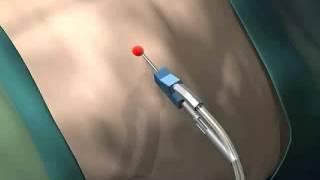 How Liposuction Works. A Detailed Animation