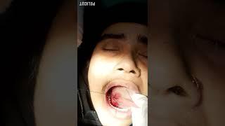 How to Take Excitional Biopsy from lateral Border of tounge