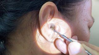 Massive Hard Dry Earwax Removed from Woman's Ear