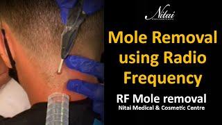 Cosmetic Mole Removal | Nitai Medical & Cosmetic Centre | Melbourne