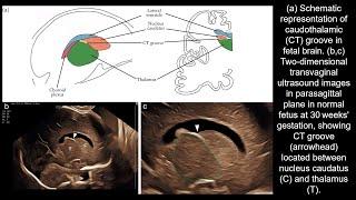 Visualization of caudothalamic groove at expert fetal neurosonography