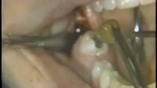 Horizontal Mandibular Impaction and Maxillary Third Molar