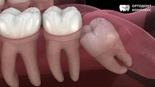 Ретинированные и дистопированные зубы мудрости