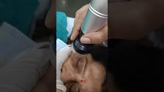 Dark circles treatment by MNRF technology.. Delhi Skin Laser Centre 99908 04085.
