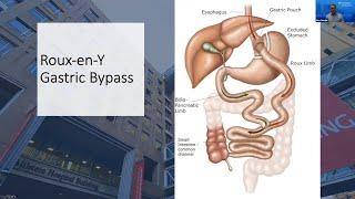 Weight Loss Surgery Q&A: Roux-en-Y Gastric Bypass