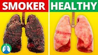 Smokers' Lungs vs. Healthy Lungs