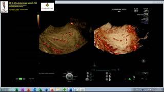 POLIP ENDOMETRIUM - PERDARAHAN DILUAR SIKLUS HAID (Dr. Wiku Andonotopo)