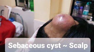 Clinical Cases - Sebaceous cyst ~ Scalp brief overview