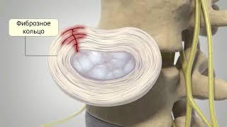 Грыжа межпозвонкового диска: причины, симптомы