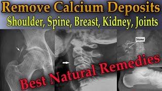 Remove Painful Calcium Deposits From Your Body (3 Best Home Remedies) - Dr Mandell