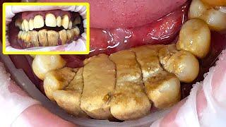 47 yo. Male's Teeth Gigantic Tartar Removal - Scaling