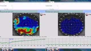 Tear film analysis