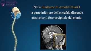 Sindrome di Arnold Chiari I, Siringomielia e Scoliosi - Institut Chiari di Barcellona