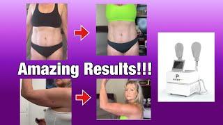 HIEMT Results!!  |  AMAZING Results from HIEMT | EMSCULPT AT HOME!!