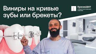  Как делают виниры на кривые зубы, в чем плюсы и минусы? Виниры на кривые зубы.