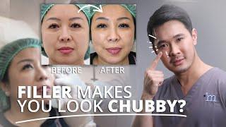 APA BENAR FILLER BISA BIKIN WAJAH TERLIHAT CHUBBY??