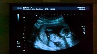 Identical twins 13 weeks ultrasound