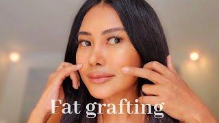 Face fat grafting update and things to know