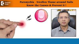 SWOLLEN TISSUE around Nails|PARONYCHIA-Causes, Prevention & Treatment-Dr.Nischal K C|Doctors' Circle