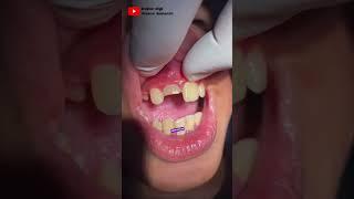 ANAK ANAK USIA 12 TAHUN DENGAN GIGI PATAH #gigipatah #anakanak #perawatansaluranakargigi #dentist