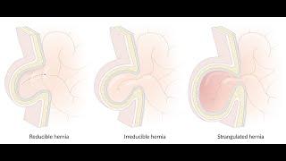 Differences between Reducible Hernia and Irreducible Hernia