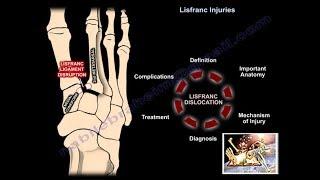 Lisfranc Injuries - Everything You Need To Know - Dr. Nabil Ebraheim