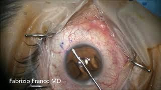 Implant XEN glaucoma filtering device (MIGS) - Fabrizio Franco MD