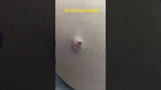 Massive blackhead extraction Dr Khaled Sadek #blackheads #shorts #drkhaledsadek