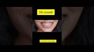 My teeth gaps #teeth #braces #viral #shorts #trending #teethgapmakeover #shortvideo  #orthodontics