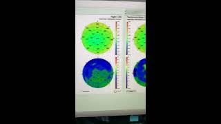 EKC scarring and vision improves with Restasis