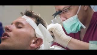 Steven's FUE Hair Transplant Procedure