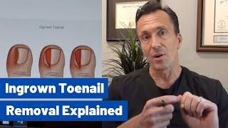 Ingrown Toenail Removal: Dr Moore Explains the Permanent, Cosmetic Procedure