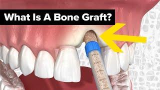 Dental Bone Grafts Explained