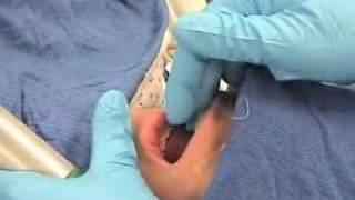 Intubation-How to perform endotracheal intubation # 2