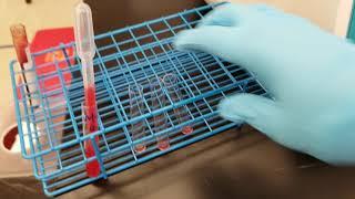 Blood Banking: Fetomaternal Hemorrhage Screen (Rosette test)