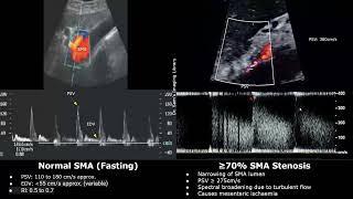 Superior Mesenteric Artery (SMA) Doppler Ultrasound Normal Vs Abnormal Images | Vascular USG Cases