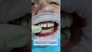 Удалили 11 зубов и поставили all on 4. 11 teeth removed and put all on 4.