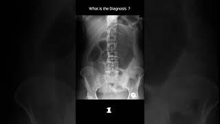 Caecal volvulus 31 Abnormal bowel gas pattern #@radiologychannel007