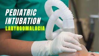 Pediatric Intubation | With Laryngomalacia