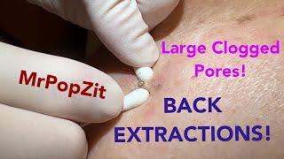 Deep clogged pores on the back extracted! Blackhead removal up close by the dozens.