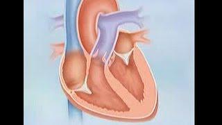 Systolic Heart Failure