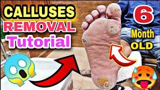  Still hard Pedicurest and Calluses tutorials, with tools and waters Asmr Footcare33